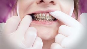 ASMR: upgraded braces with chain-link rubber bands and nitrile gloves (Arya Grander)