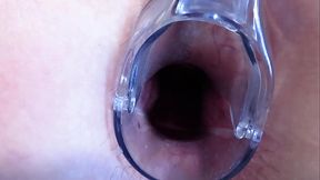 Stretching the anal and vagina with a gynecological speculum. MILF with a big butt and a gaping asshole and a gaping pussy.