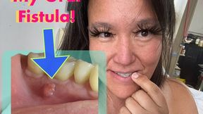 Long Root Canal update: Ugh not looking forward to the pain (Aug 29 2025)