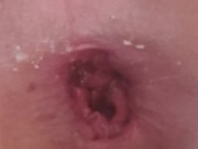 my anal is so lose and broken i cant hold anything in