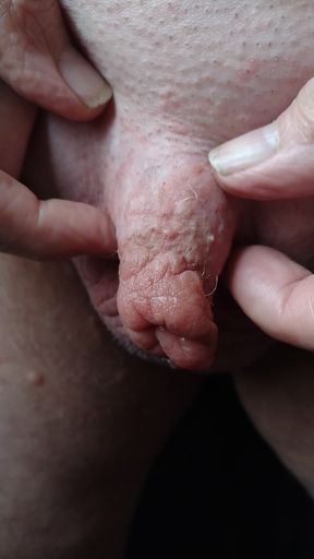Puffy foreskin from nettling mmm so nice!