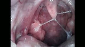 Phlegm endoscopy of the throat & nose