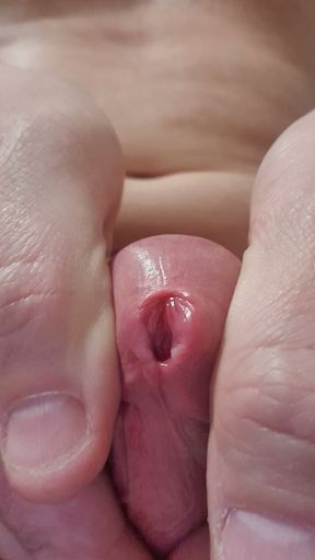 Extremely stretched hole after dilator play